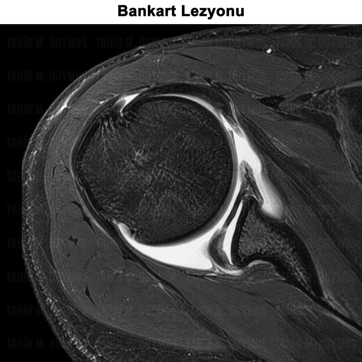 Bankart Lezyonu: Nedir? Belirtileri, Tedavisi ve Ameliyatı