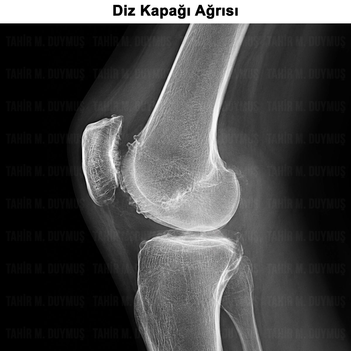 Diz Kapağı Ağrısı: Nedenleri, Belirtileri ve Tedavisi