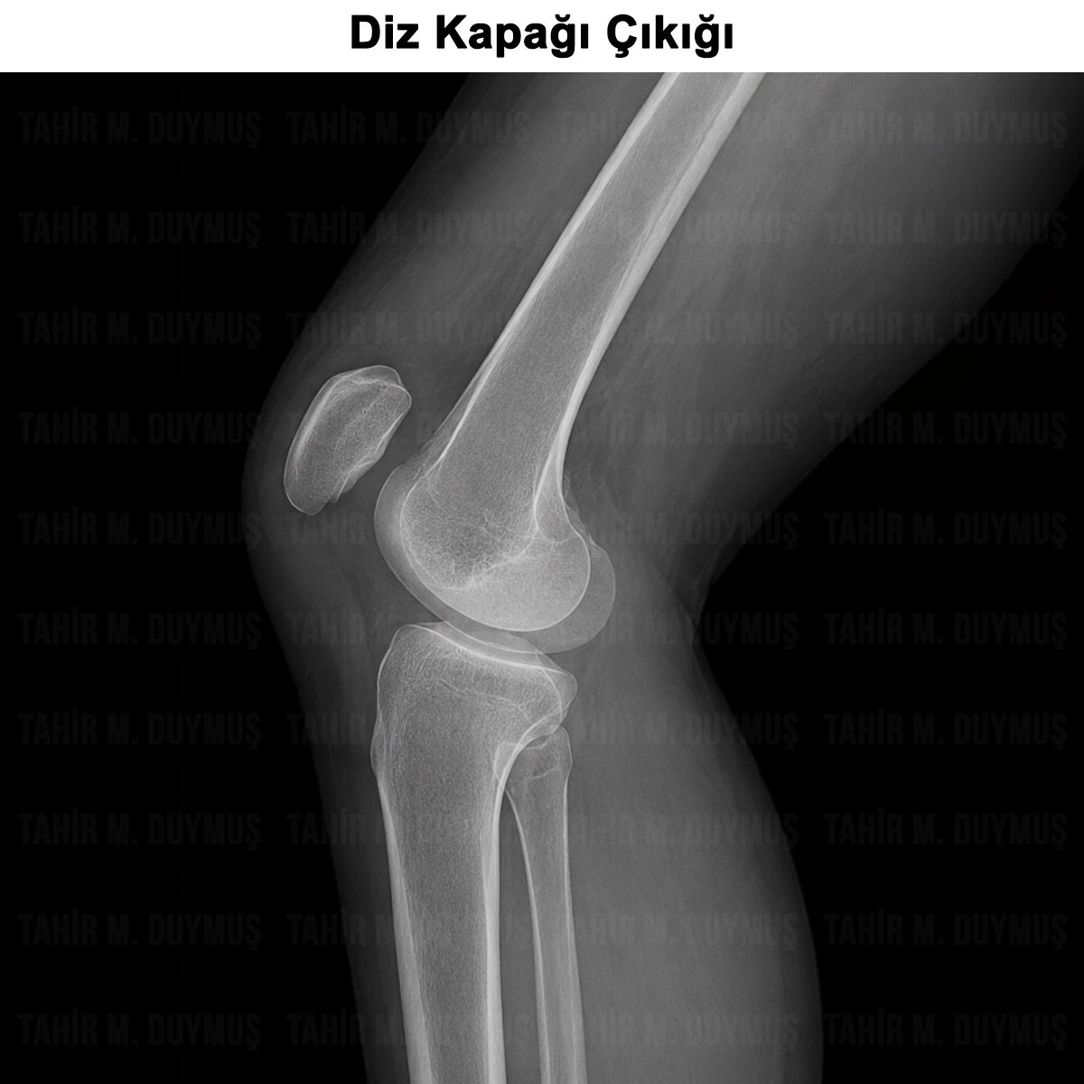 Diz Kapağı Çıkığı: Nedenleri, Belirtileri, Tanı ve Tedavisi