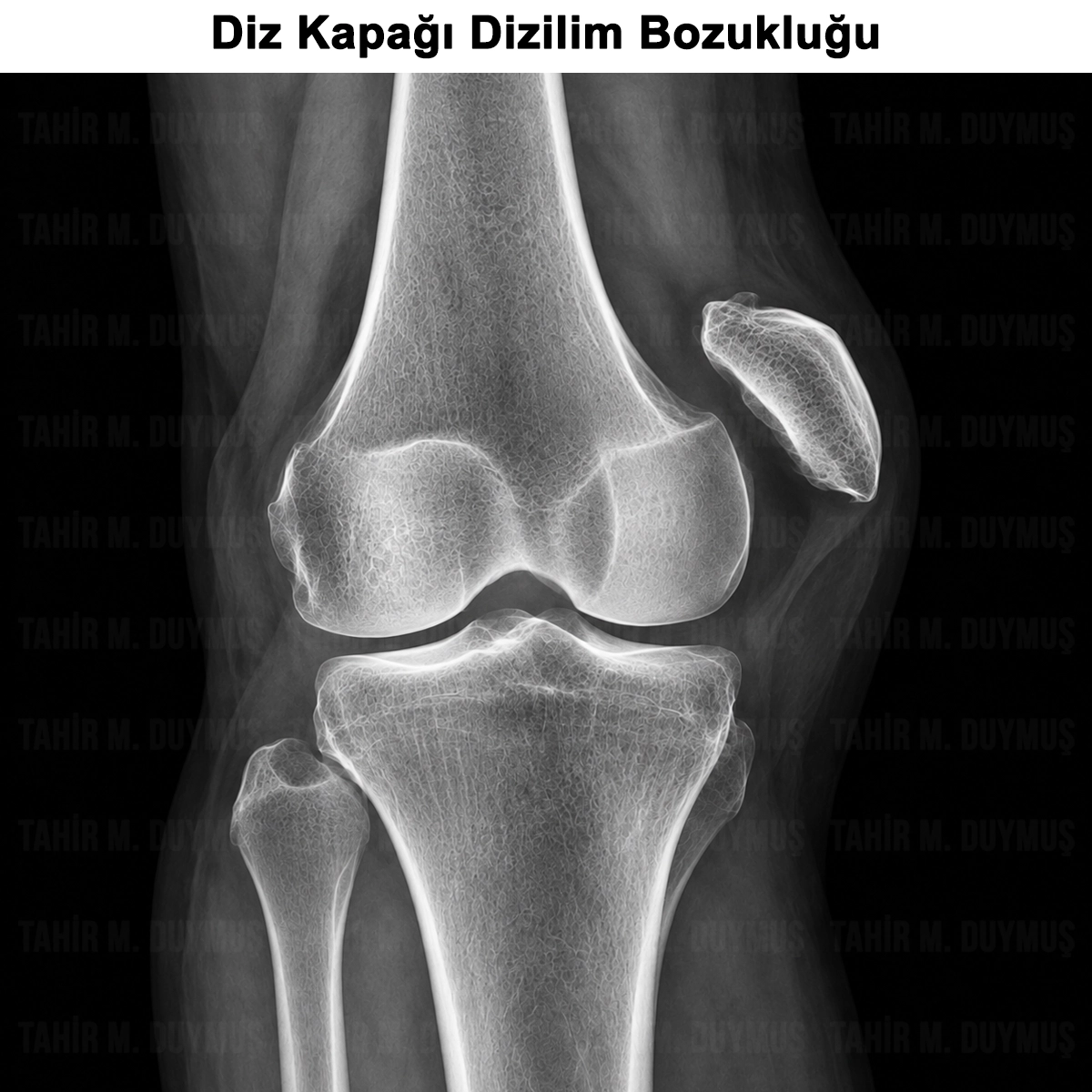 Diz Kapağı Dizilim Bozukluğu: Nedir? Tanısı ve Tedavisi
