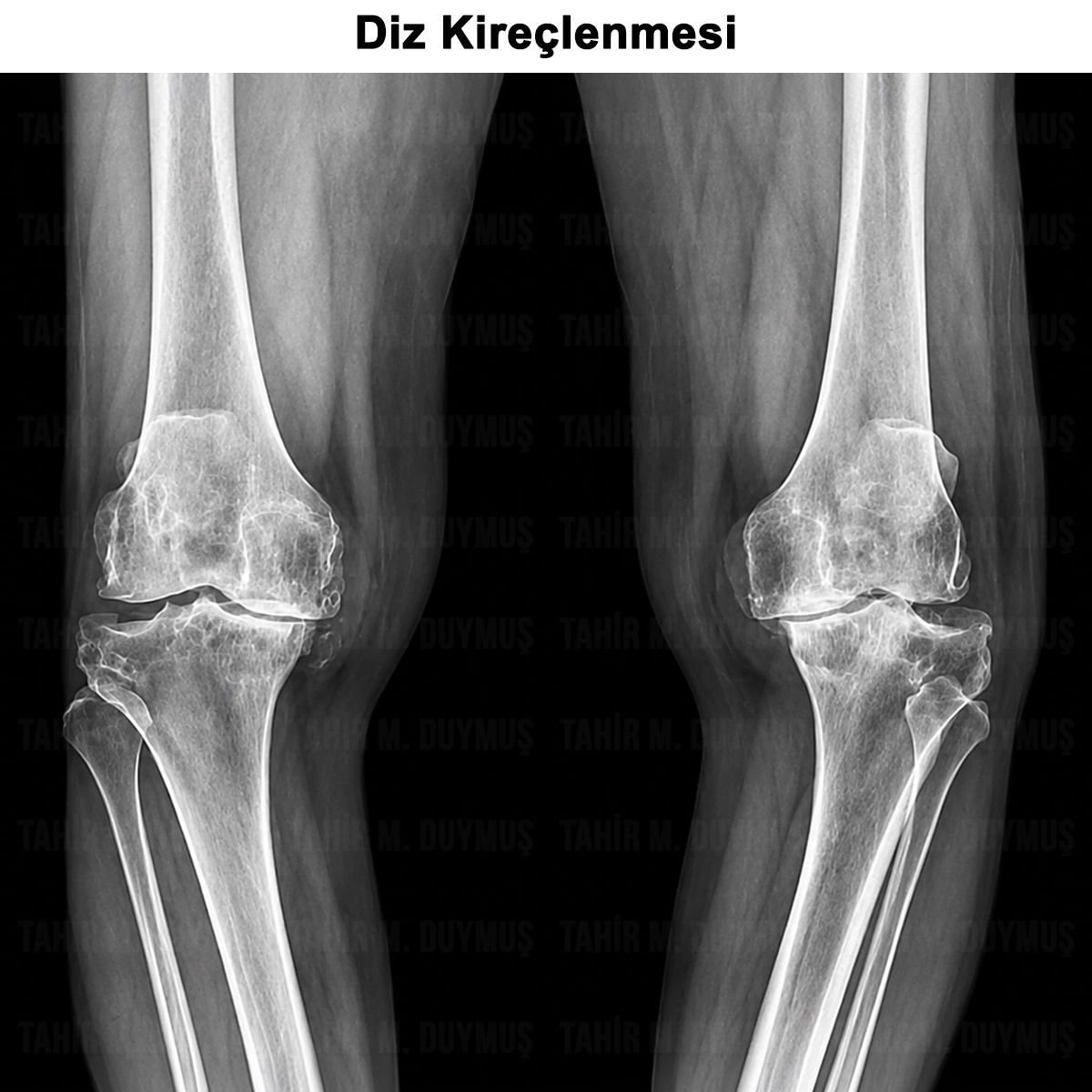 Diz Kireçlenmesi: Nedenleri, Belirtileri, Tanı ve Tedavisi