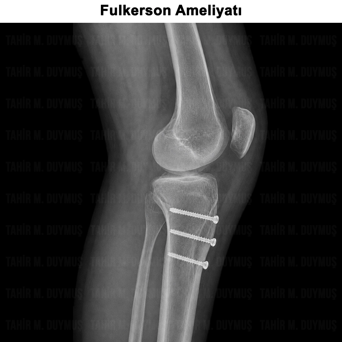 Fulkerson Cerrahisi (Diz Kapağı Ameliyatı)