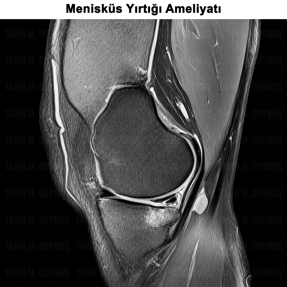 Menisküs Yırtığı: Nedir? Belirtileri? Tanı ve Tedavisi