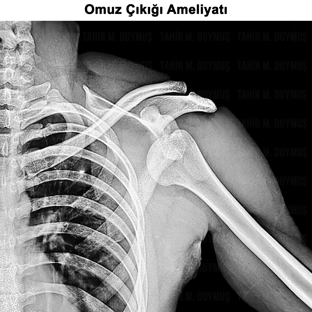 Omuz Çıkığı: Nedir? Nedenleri, Tedavisi ve Ameliyatı
