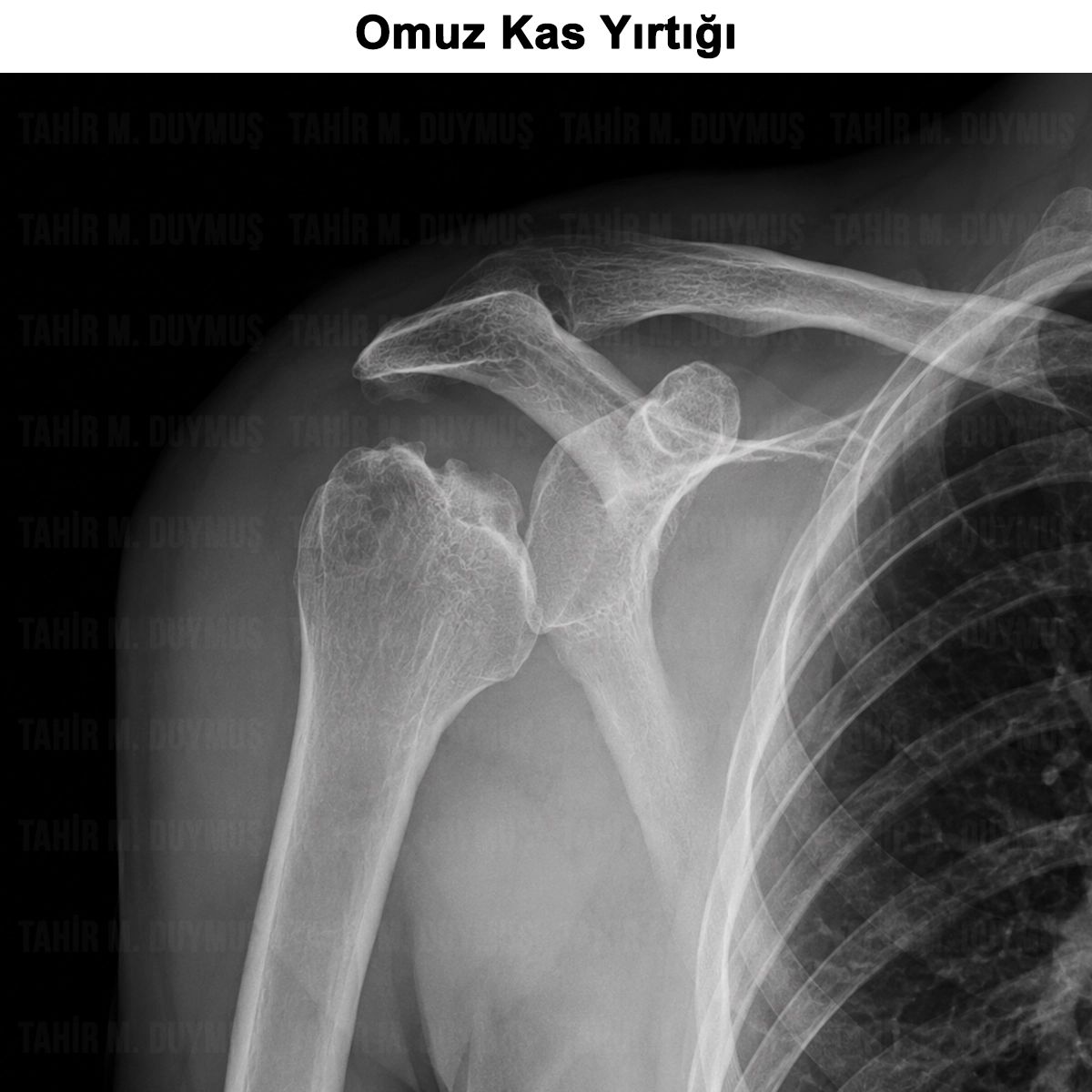 Omuz Kas Yırtığı Nedir? Belirtileri ve Tedavisi
