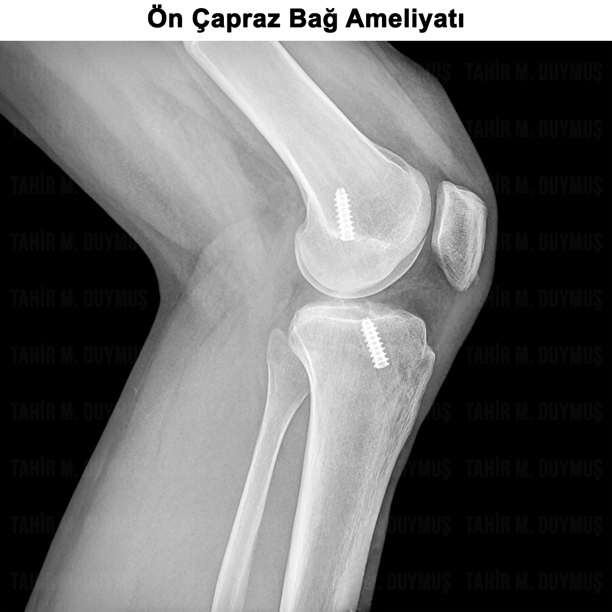 Ön Çapraz Bağ Kopması: Nedir? Belirtileri, Tanısı, Tedavisi
