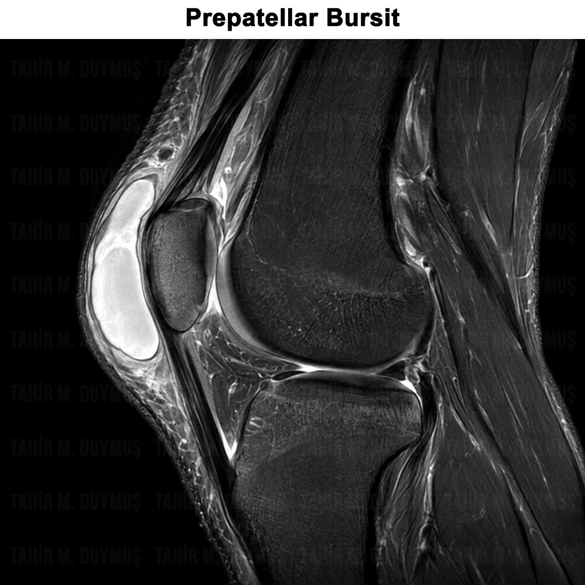 Prepatellar Bursit: Nedir? Neden Olur? Tanısı ve Tedavisi